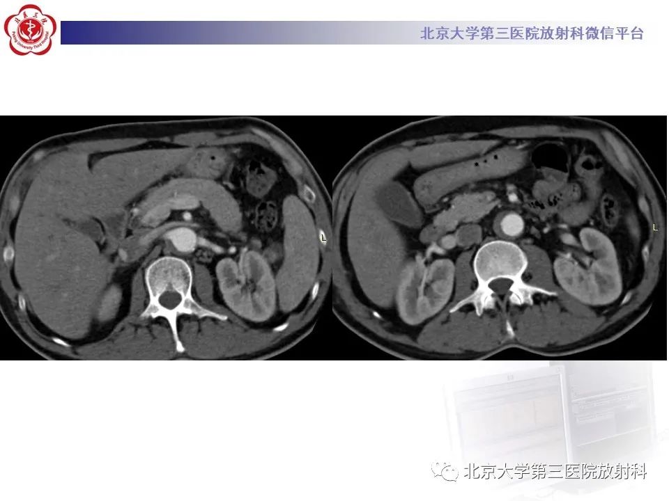 影像PPT - 【PPT】1例STANFORD A型主动脉壁内血肿转化夹层手术治影像学表现-17