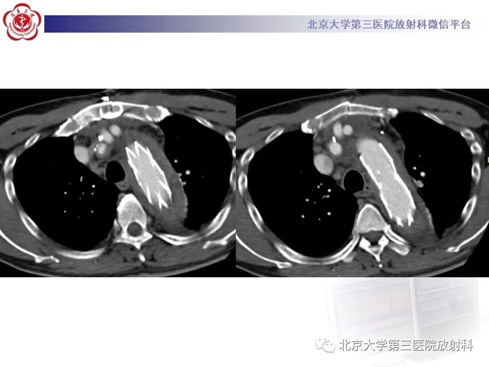 影像PPT - 【PPT】1例STANFORD A型主动脉壁内血肿转化夹层手术治影像学表现-14