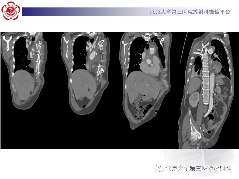 影像PPT - 【PPT】1例STANFORD A型主动脉壁内血肿转化夹层手术治影像学表现-18