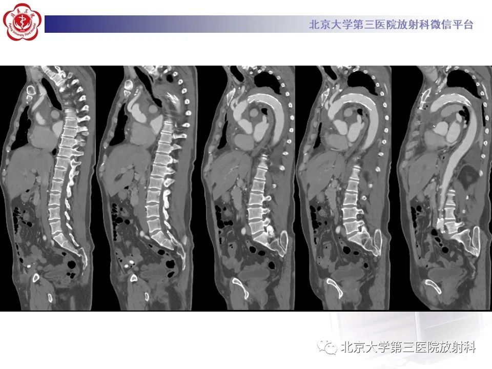影像PPT - 【PPT】1例STANFORD A型主动脉壁内血肿转化夹层手术治影像学表现-19