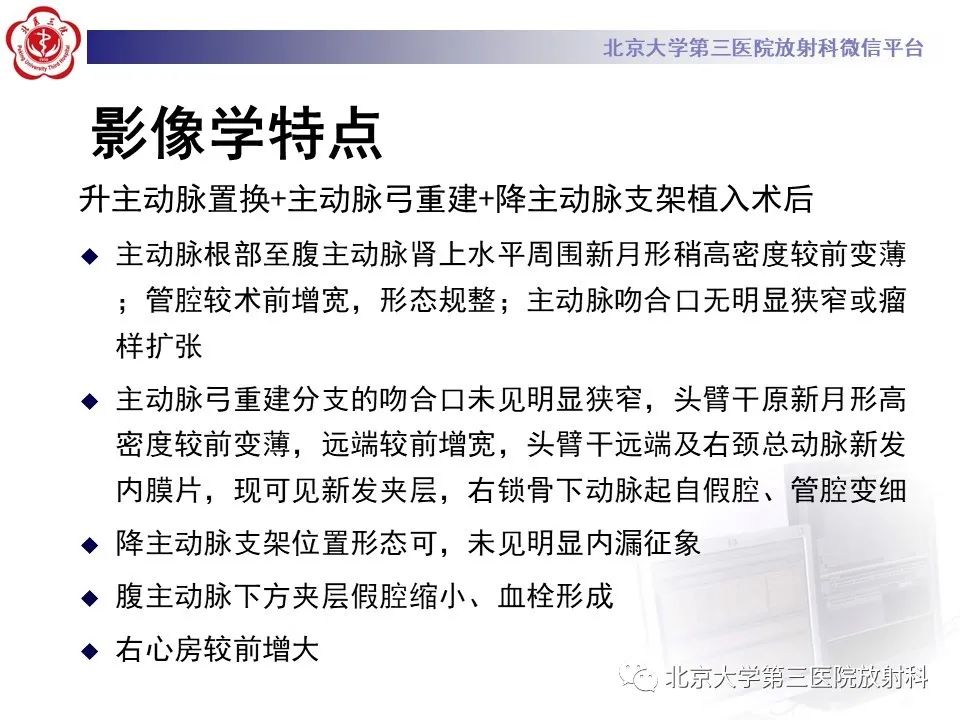 影像PPT - 【PPT】1例STANFORD A型主动脉壁内血肿转化夹层手术治影像学表现-20