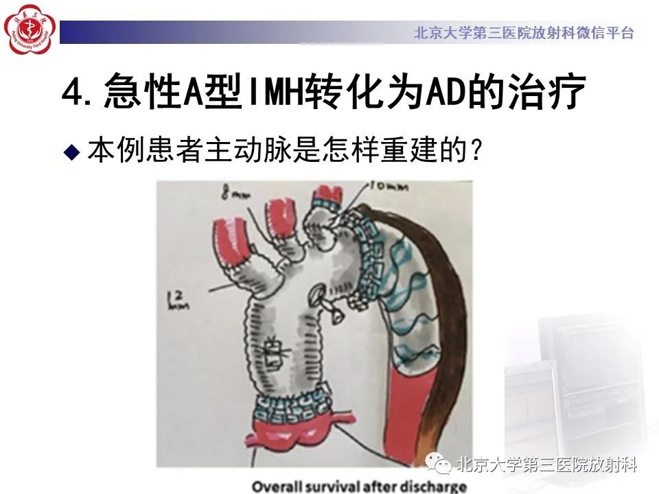 影像PPT - 【PPT】1例STANFORD A型主动脉壁内血肿转化夹层手术治影像学表现-30