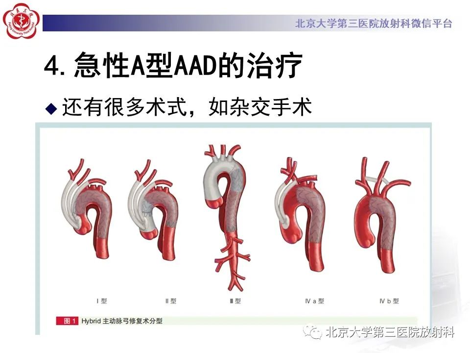 影像PPT - 【PPT】1例STANFORD A型主动脉壁内血肿转化夹层手术治影像学表现-33
