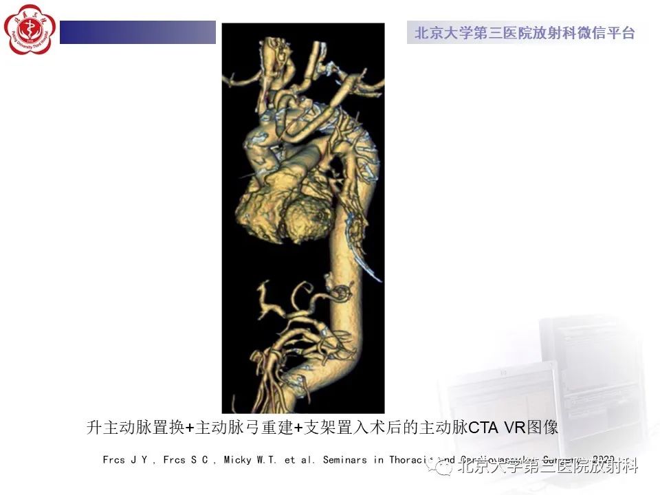 影像PPT - 【PPT】1例STANFORD A型主动脉壁内血肿转化夹层手术治影像学表现-32