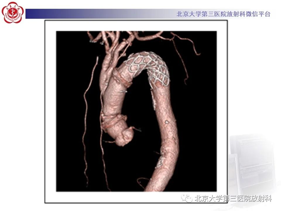 影像PPT - 【PPT】1例STANFORD A型主动脉壁内血肿转化夹层手术治影像学表现-34