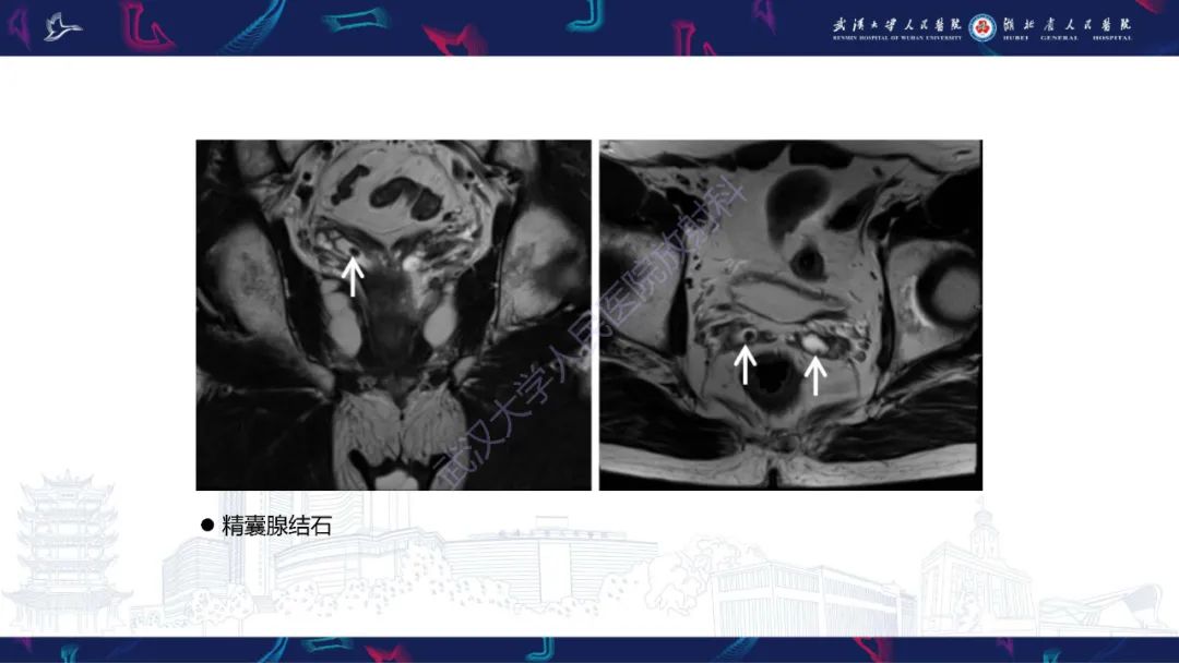 影像PPT - 【PPT】前列腺周围病变MRI诊断-12