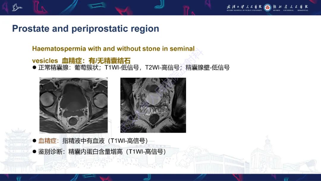影像PPT - 【PPT】前列腺周围病变MRI诊断-9