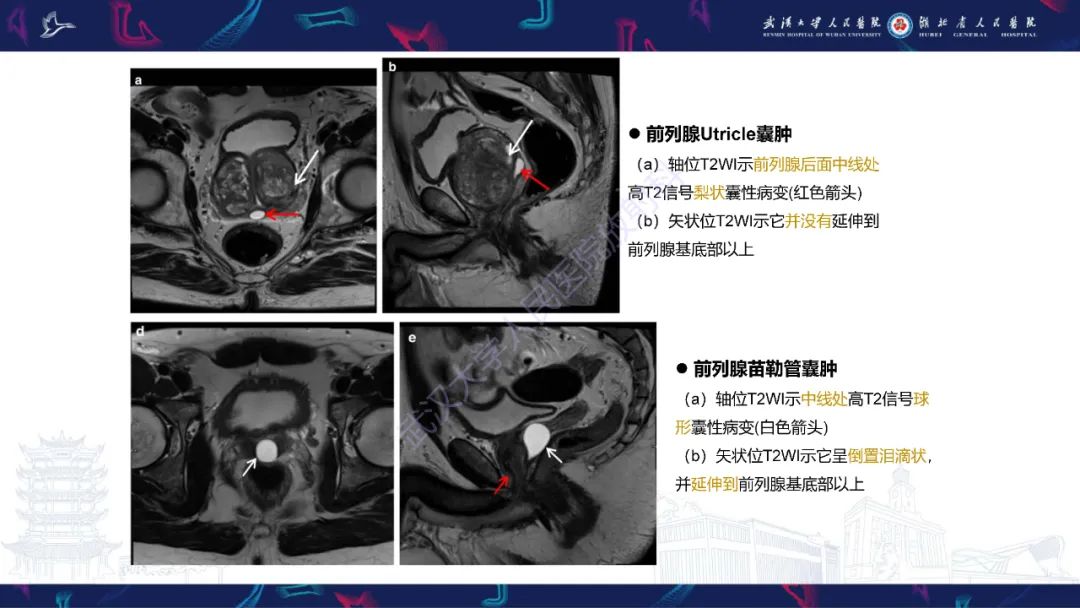 影像PPT - 【PPT】前列腺周围病变MRI诊断-16