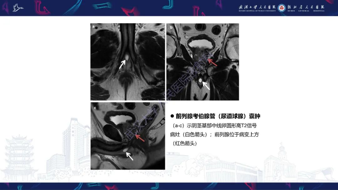 影像PPT - 【PPT】前列腺周围病变MRI诊断-20