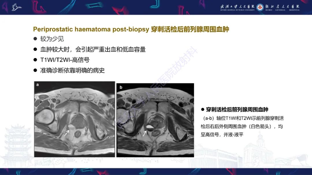 影像PPT - 【PPT】前列腺周围病变MRI诊断-21