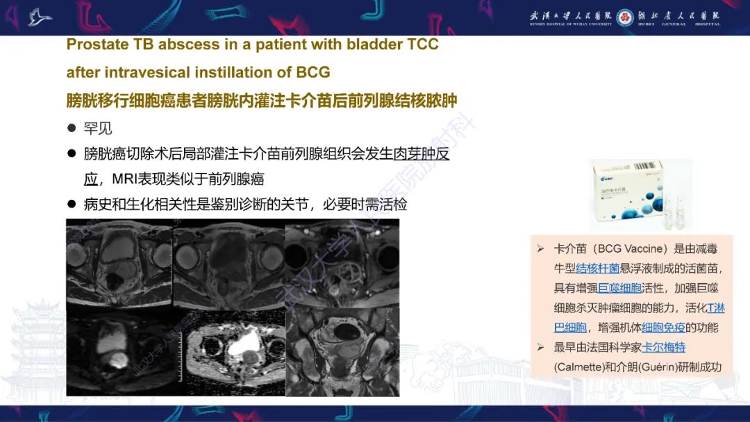 影像PPT - 【PPT】前列腺周围病变MRI诊断-22