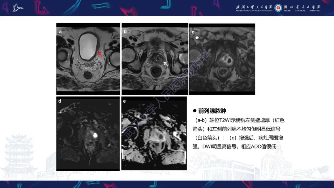 影像PPT - 【PPT】前列腺周围病变MRI诊断-23