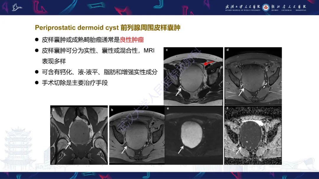 影像PPT - 【PPT】前列腺周围病变MRI诊断-24