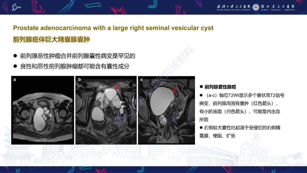 影像PPT - 【PPT】前列腺周围病变MRI诊断-25