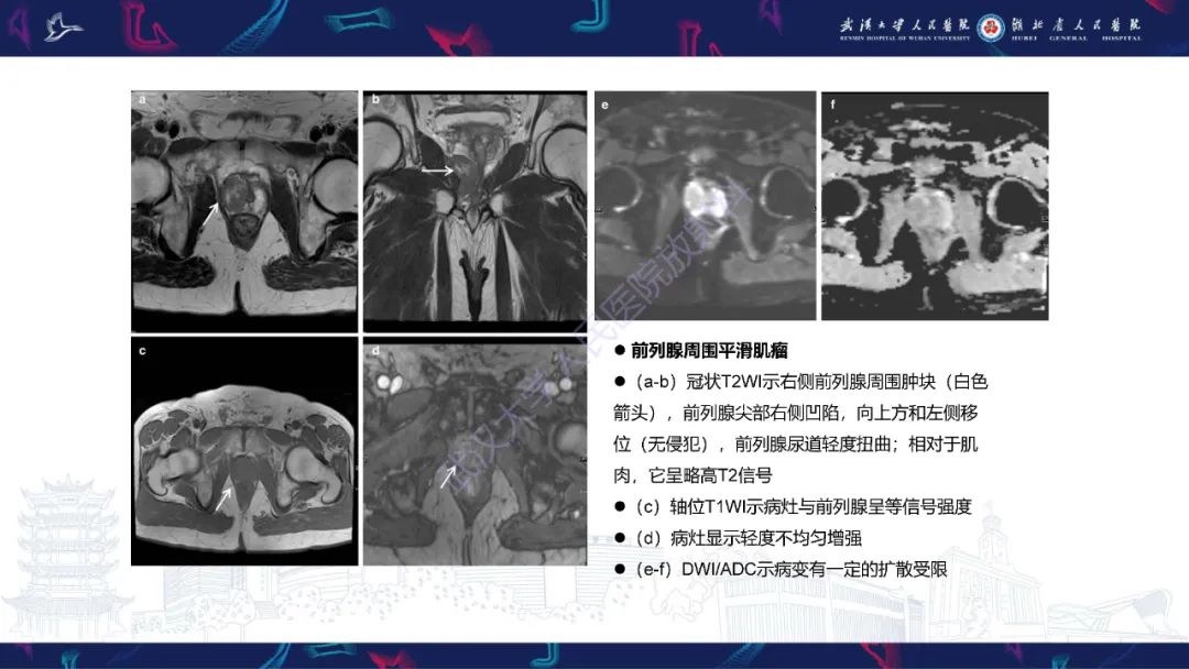 影像PPT - 【PPT】前列腺周围病变MRI诊断-29