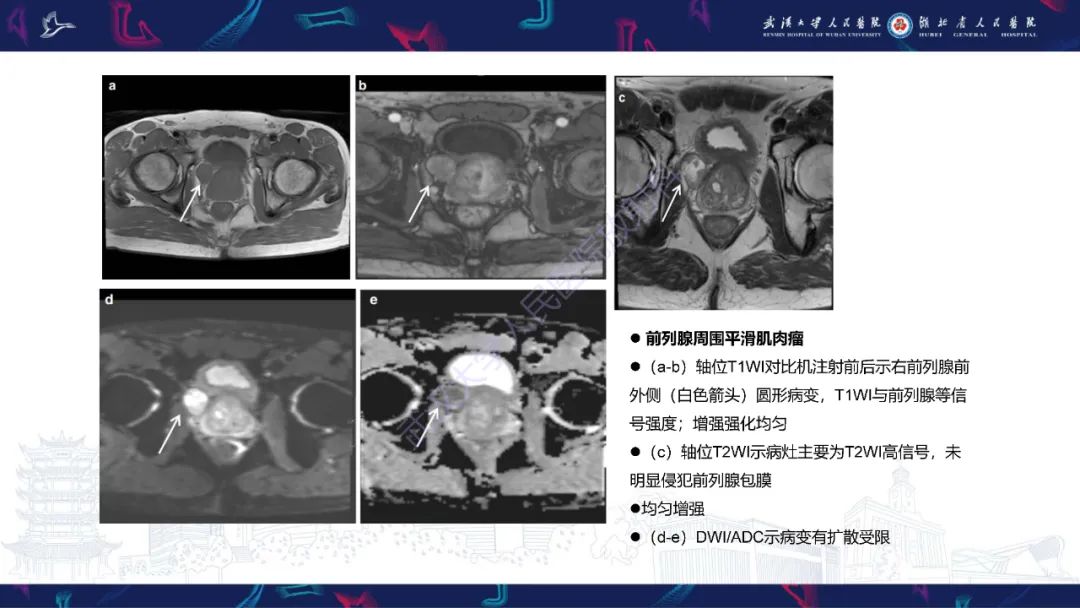 影像PPT - 【PPT】前列腺周围病变MRI诊断-31