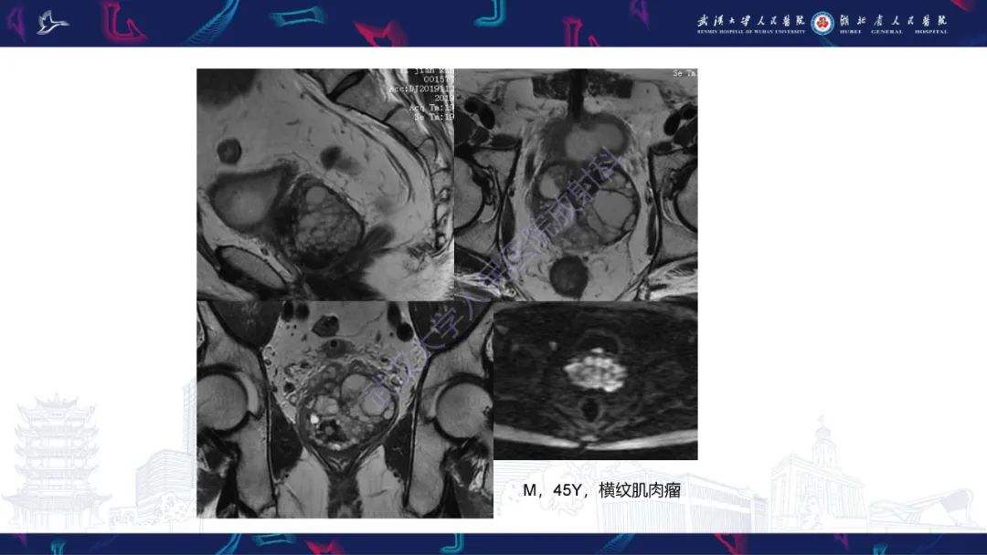 影像PPT - 【PPT】前列腺周围病变MRI诊断-32