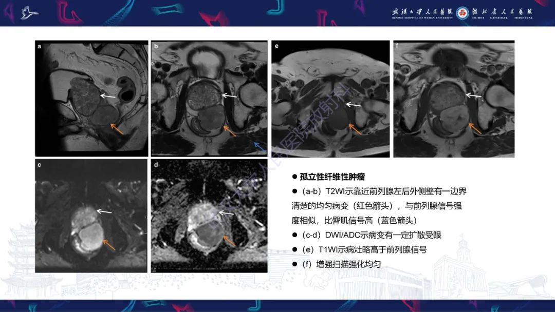 影像PPT - 【PPT】前列腺周围病变MRI诊断-34