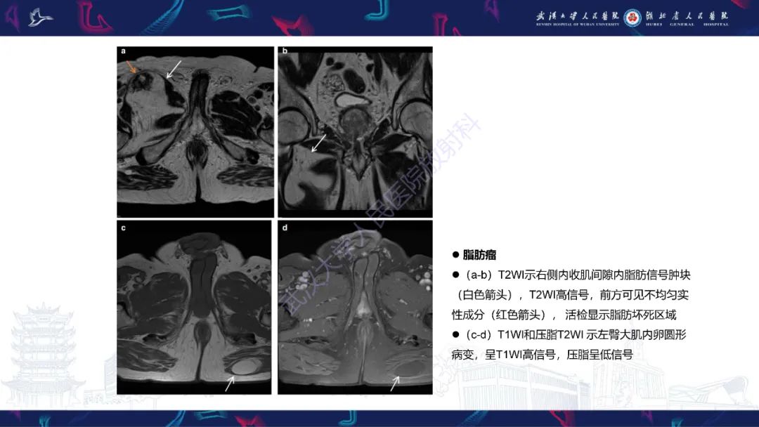 影像PPT - 【PPT】前列腺周围病变MRI诊断-36