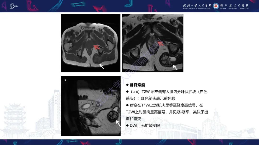 影像PPT - 【PPT】前列腺周围病变MRI诊断-39