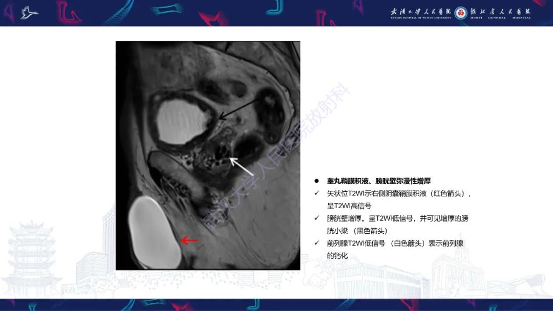 影像PPT - 【PPT】前列腺周围病变MRI诊断-41