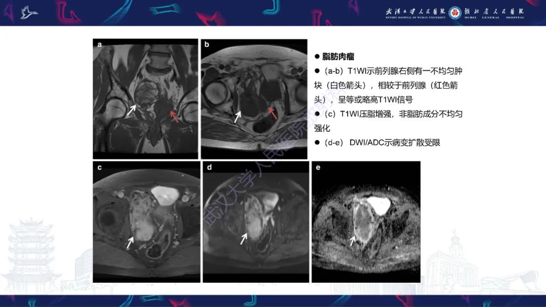影像PPT - 【PPT】前列腺周围病变MRI诊断-37