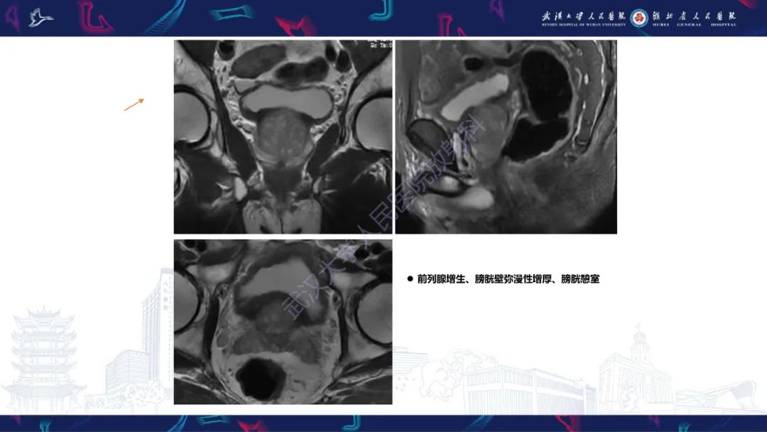 影像PPT - 【PPT】前列腺周围病变MRI诊断-42