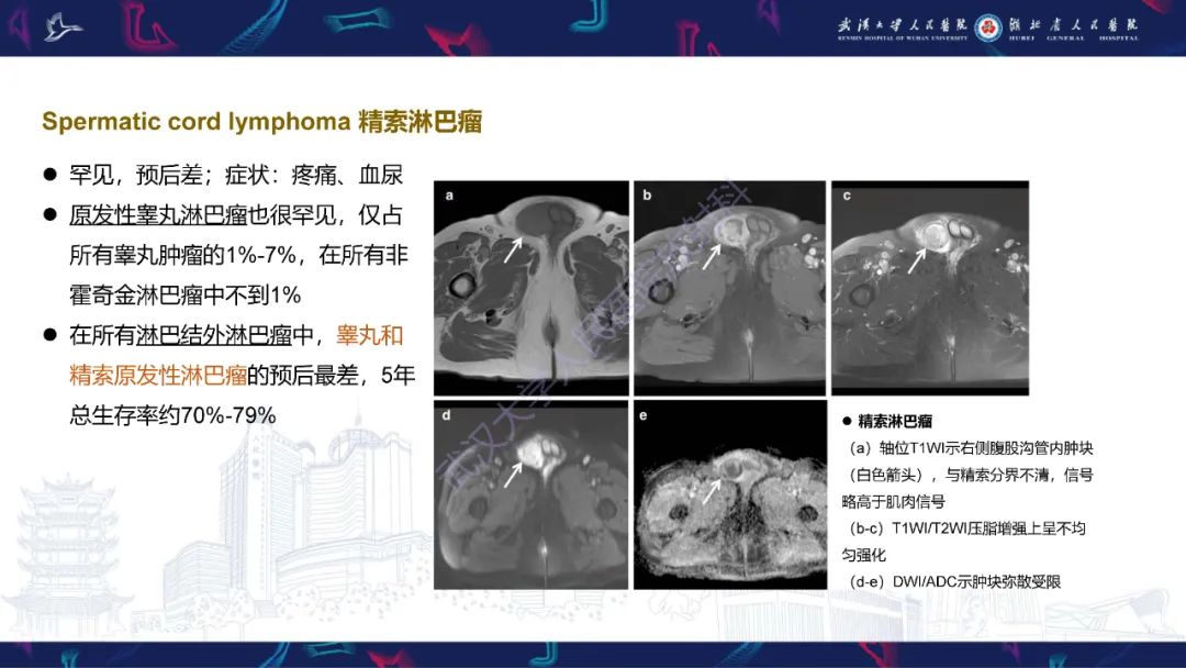 影像PPT - 【PPT】前列腺周围病变MRI诊断-46