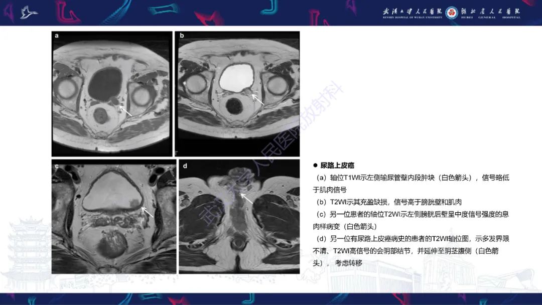 影像PPT - 【PPT】前列腺周围病变MRI诊断-48