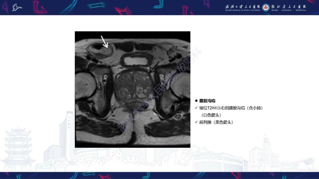 影像PPT - 【PPT】前列腺周围病变MRI诊断-51