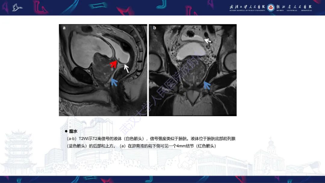 影像PPT - 【PPT】前列腺周围病变MRI诊断-53