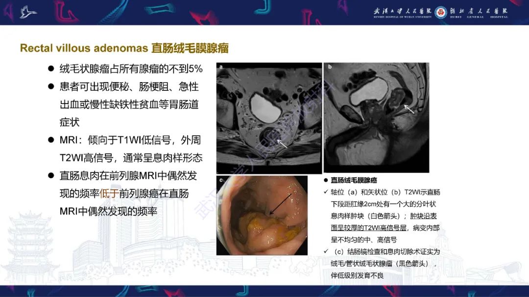 影像PPT - 【PPT】前列腺周围病变MRI诊断-55