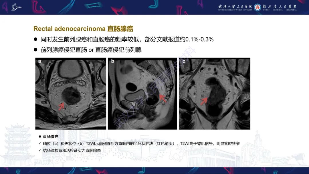 影像PPT - 【PPT】前列腺周围病变MRI诊断-56