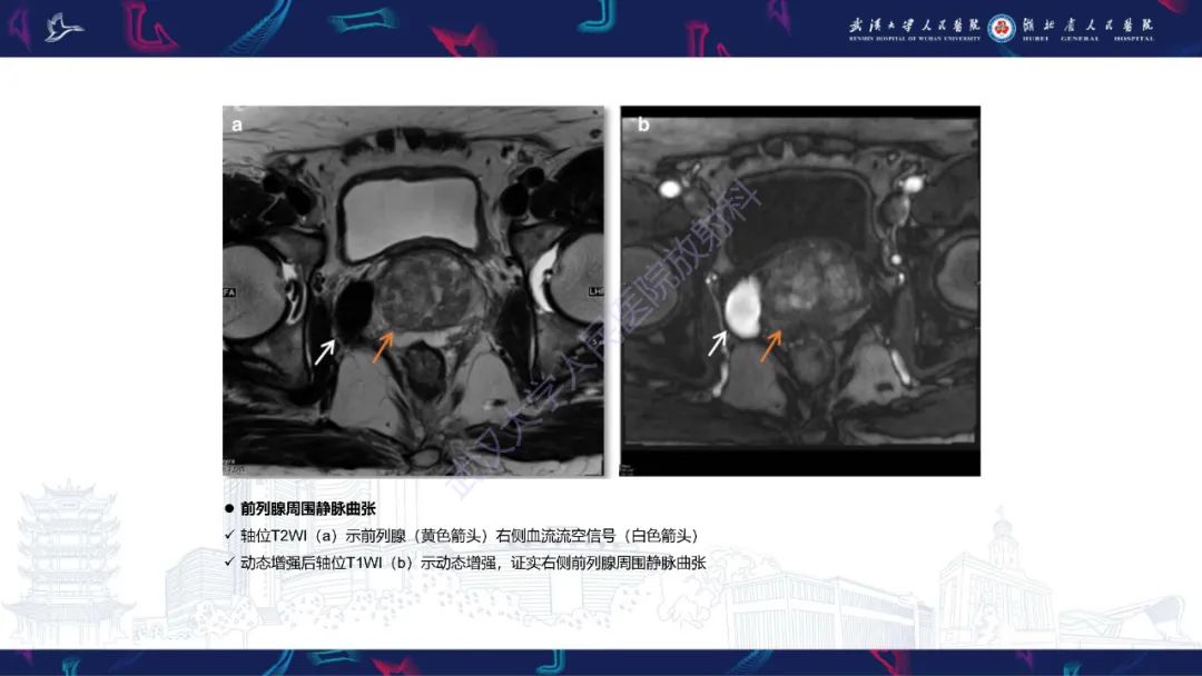 影像PPT - 【PPT】前列腺周围病变MRI诊断-58