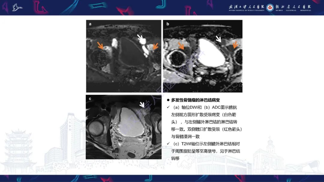 影像PPT - 【PPT】前列腺周围病变MRI诊断-60