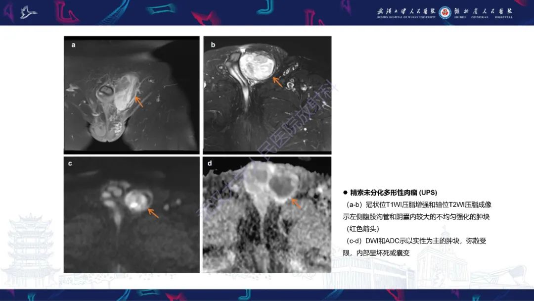 影像PPT - 【PPT】前列腺周围病变MRI诊断-3