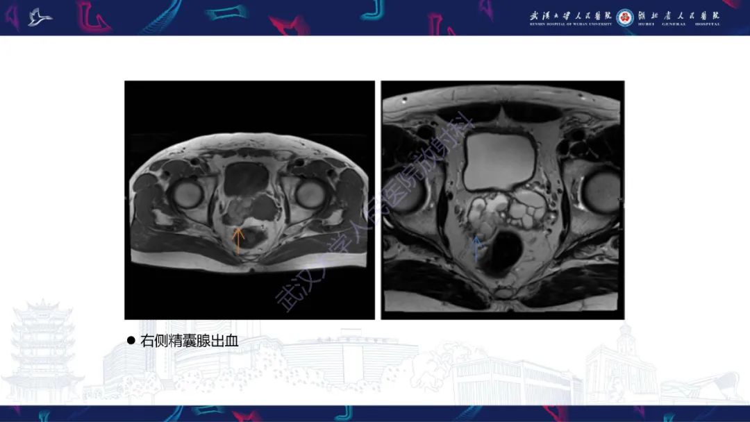 影像PPT - 【PPT】前列腺周围病变MRI诊断-2