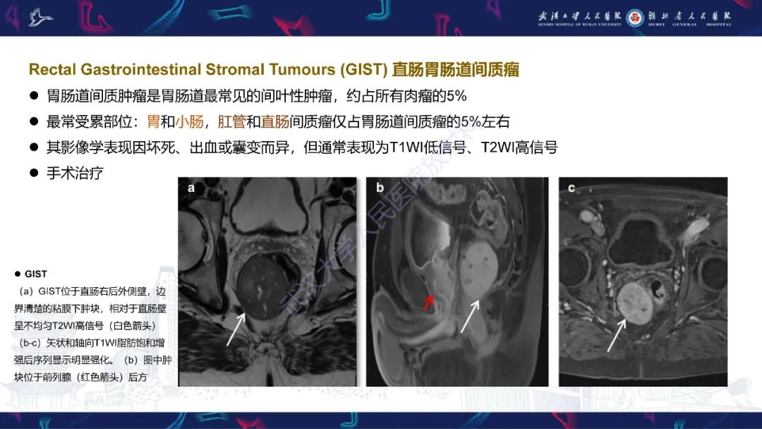 影像PPT - 【PPT】前列腺周围病变MRI诊断-4