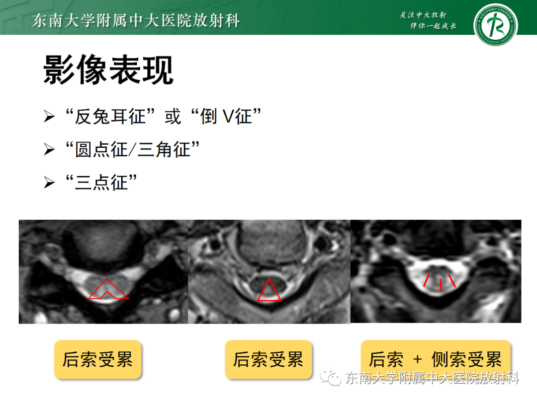 影像PPT - 【PPT】脊髓亚急性联合变性-13 影像PPT - 【PPT】脊髓亚急性联合变性-13