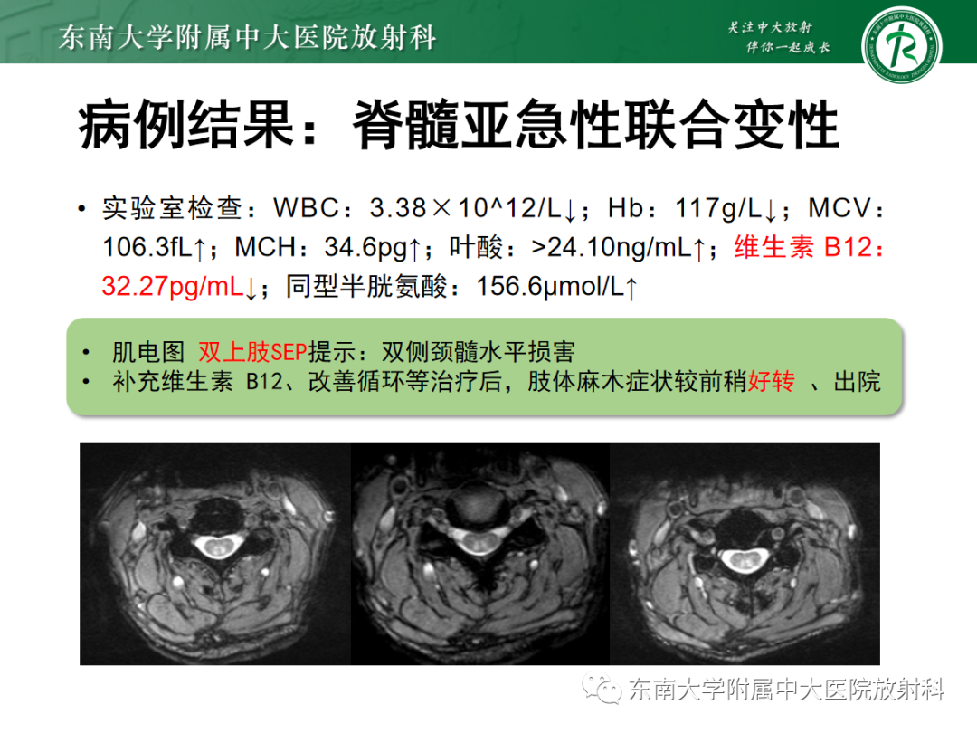 影像PPT - 【PPT】脊髓亚急性联合变性-3 影像PPT - 【PPT】脊髓亚急性联合变性-3