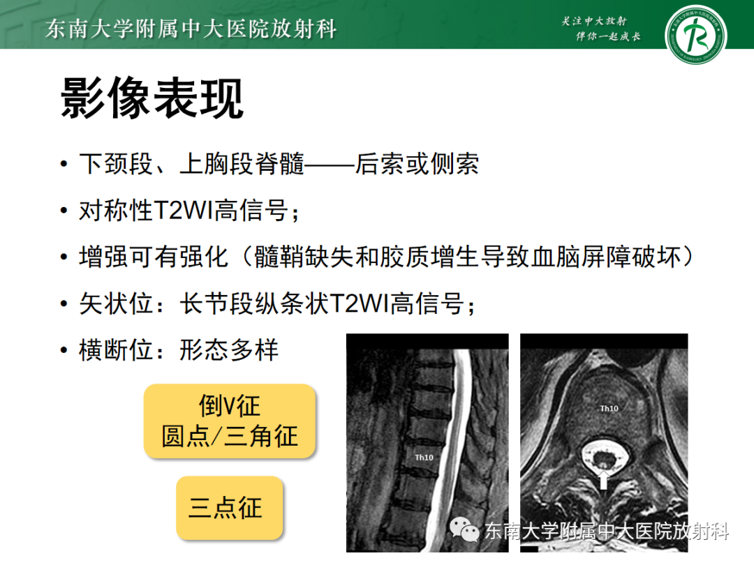 影像PPT - 【PPT】脊髓亚急性联合变性-12 影像PPT - 【PPT】脊髓亚急性联合变性-12