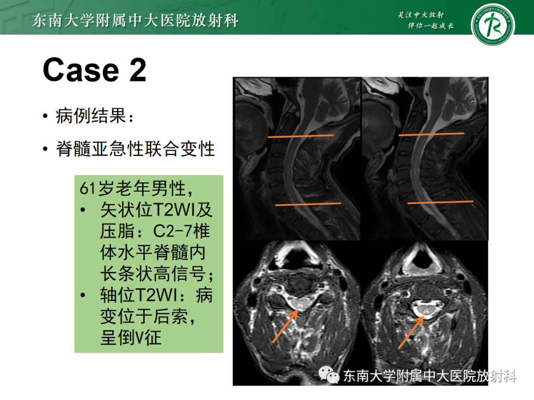 影像PPT - 【PPT】脊髓亚急性联合变性-16 影像PPT - 【PPT】脊髓亚急性联合变性-16