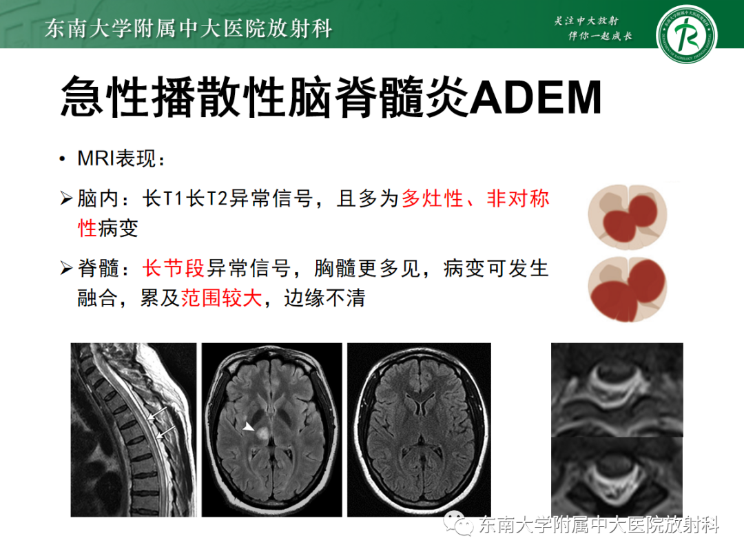影像PPT - 【PPT】脊髓亚急性联合变性-21 影像PPT - 【PPT】脊髓亚急性联合变性-21