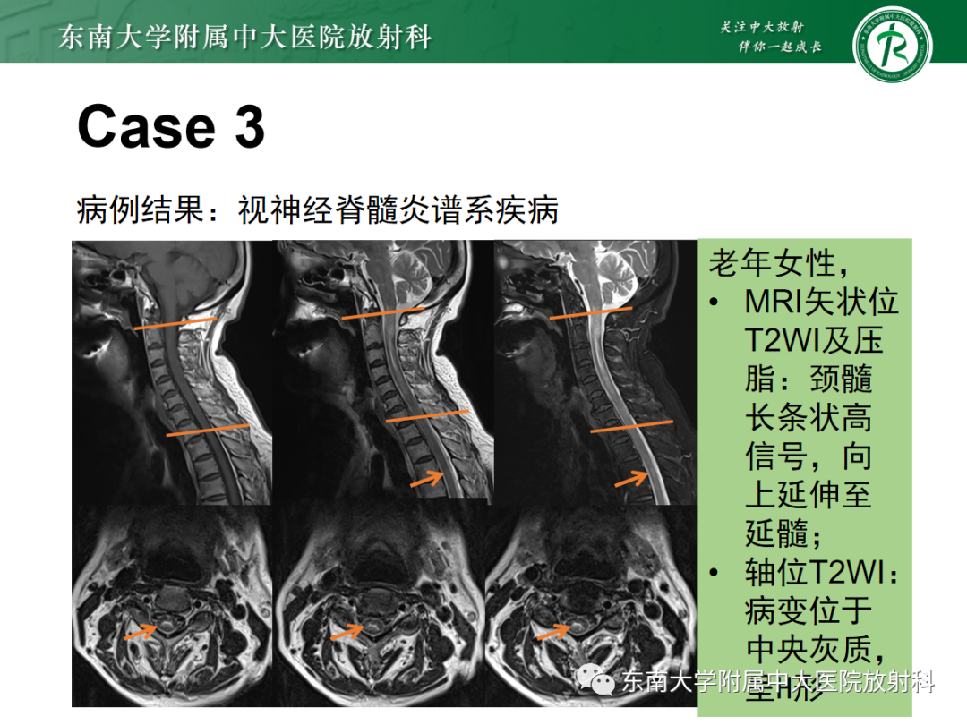 影像PPT - 【PPT】脊髓亚急性联合变性-23 影像PPT - 【PPT】脊髓亚急性联合变性-23