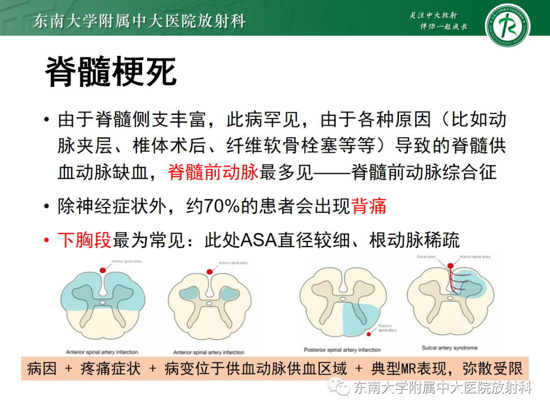 影像PPT - 【PPT】脊髓亚急性联合变性-28 影像PPT - 【PPT】脊髓亚急性联合变性-28