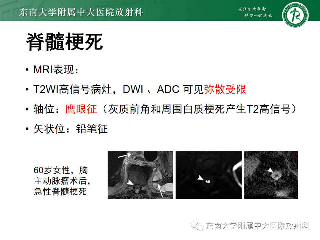 影像PPT - 【PPT】脊髓亚急性联合变性-29 影像PPT - 【PPT】脊髓亚急性联合变性-29