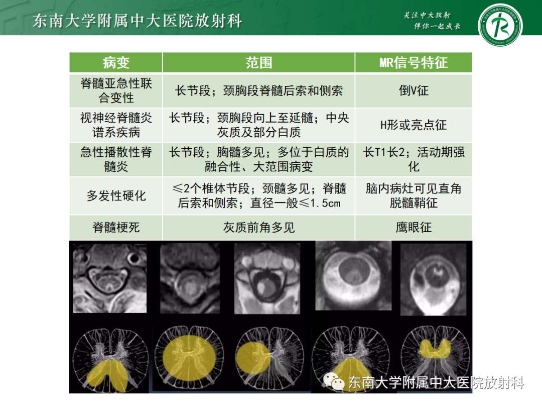 影像PPT - 【PPT】脊髓亚急性联合变性-30 影像PPT - 【PPT】脊髓亚急性联合变性-30