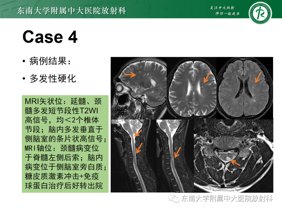 影像PPT - 【PPT】脊髓亚急性联合变性-27 影像PPT - 【PPT】脊髓亚急性联合变性-27