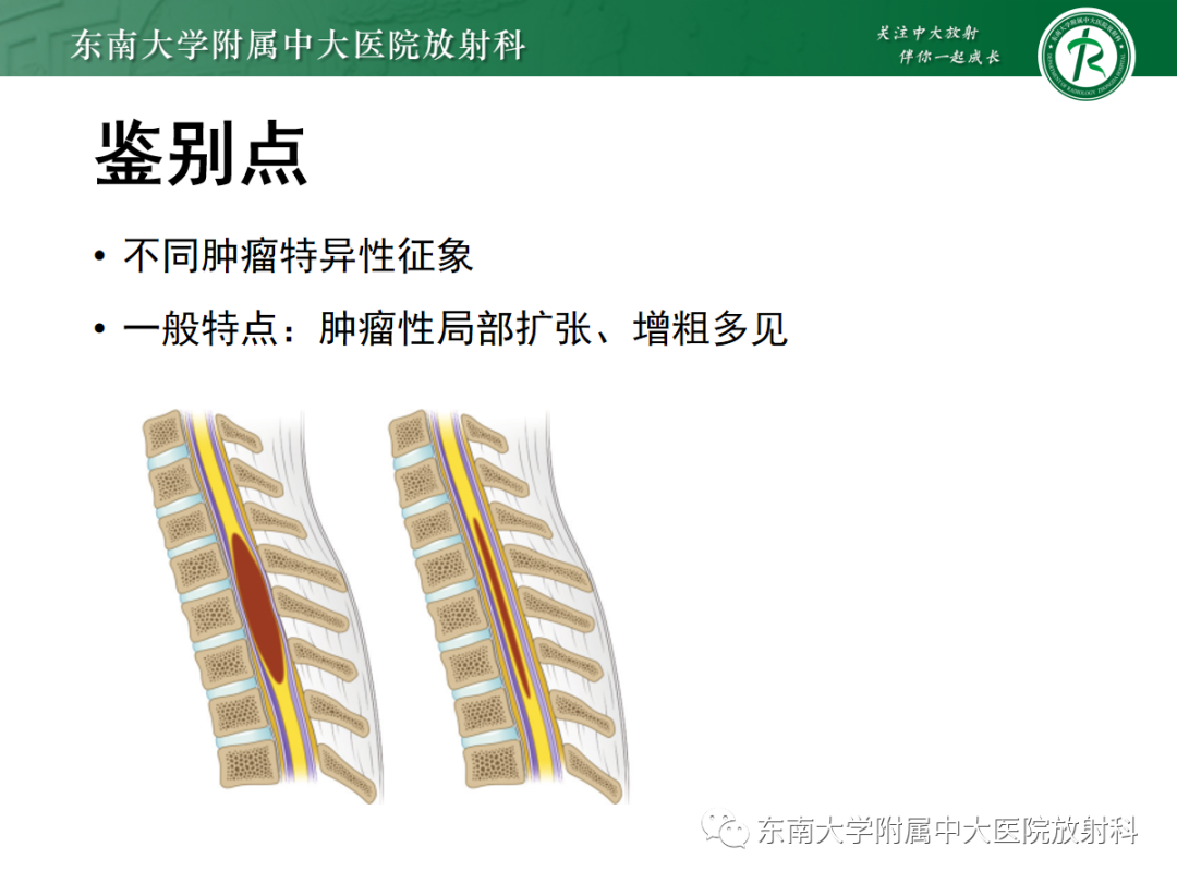 影像PPT - 【PPT】脊髓亚急性联合变性-32 影像PPT - 【PPT】脊髓亚急性联合变性-32