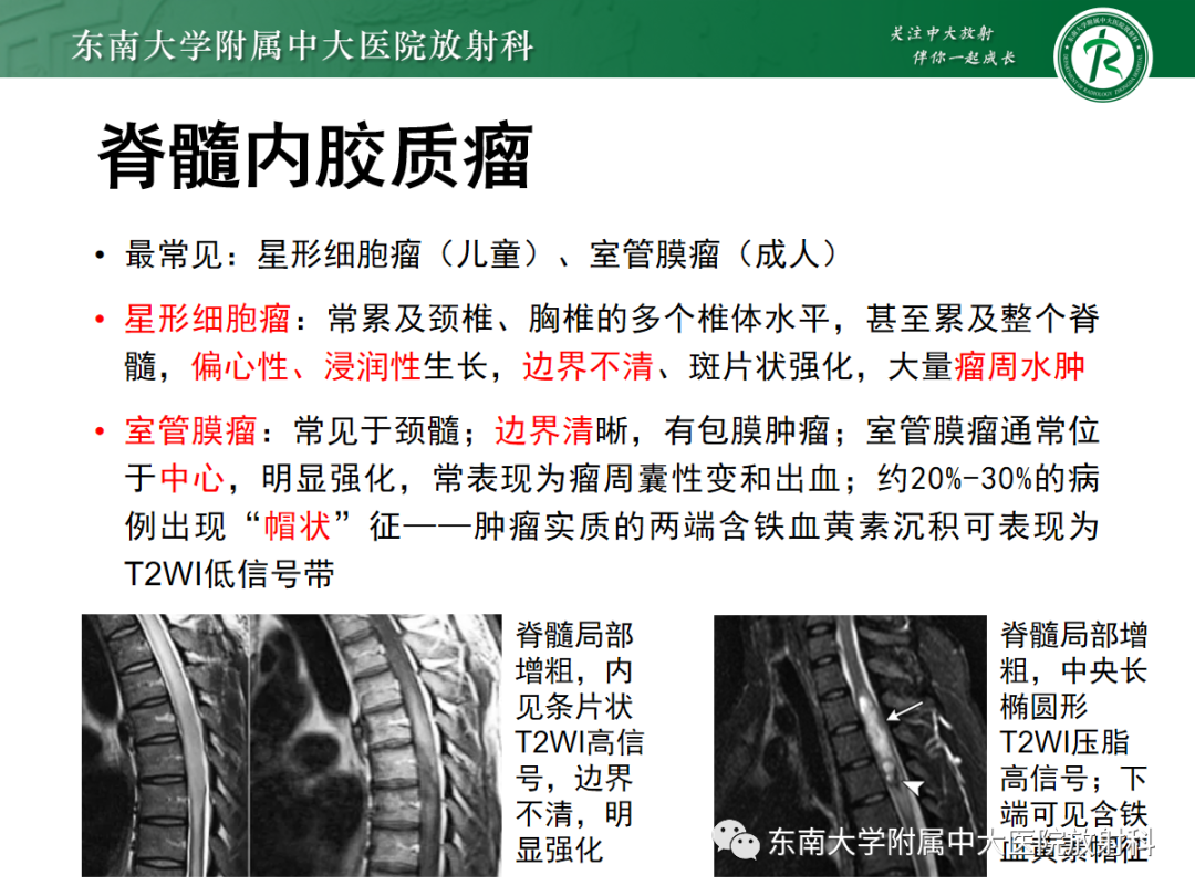 影像PPT - 【PPT】脊髓亚急性联合变性-31 影像PPT - 【PPT】脊髓亚急性联合变性-31